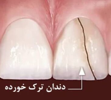 ترک و شکستگی دندان