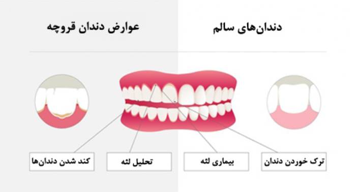 عوارض دندان قروچه