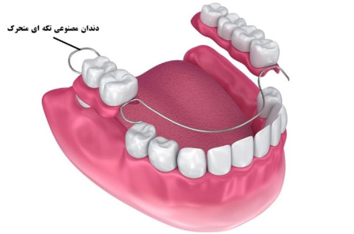 دندان مصنوعی تکه‌ای (پروتز پارسیل)