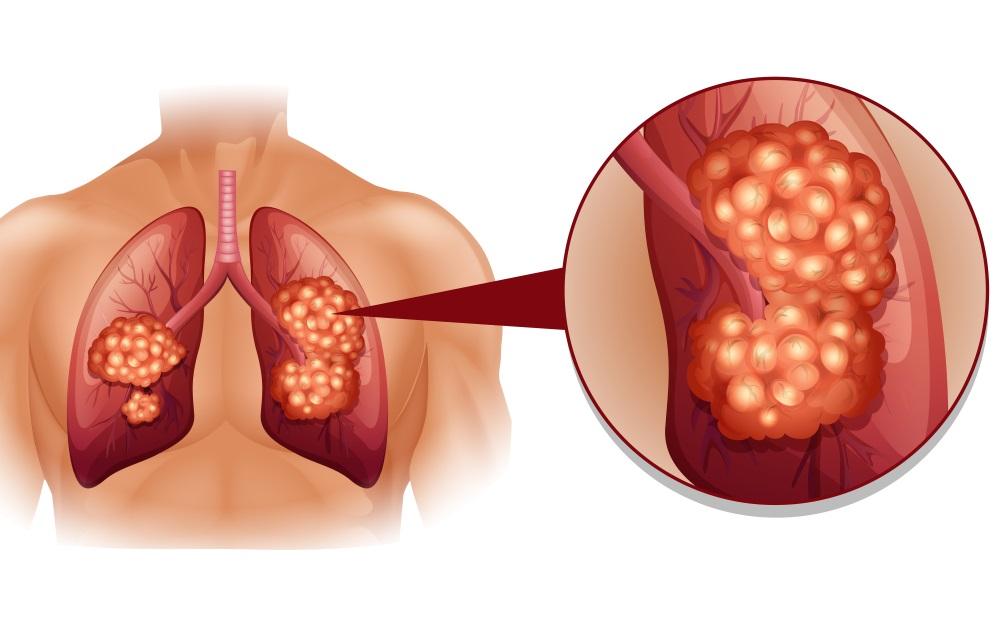 علائم و نشانه های اصلی سرطان ریه,سرطان ریه