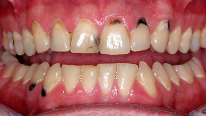 لمینت دندان و پوسیدگی دندان 