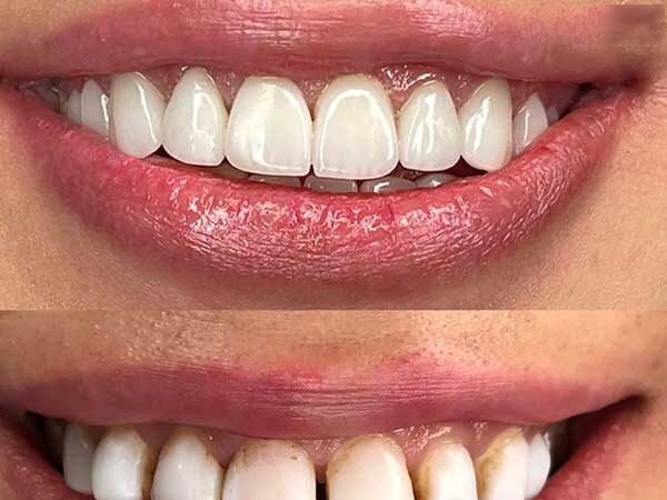 لمینت دندان و پوسیدگی دندان
