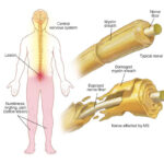 علائم اولیه ام اس و راه های تشخیص زودهنگام