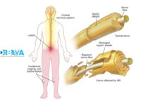 علائم اولیه ام اس و راه های تشخیص زودهنگام