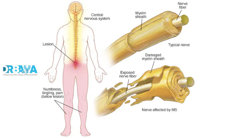 علائم اولیه ام اس و راه های تشخیص زودهنگام