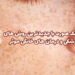 رفع لک صورت با جدیدترین روش های پزشکی و درمان های خانگی موثر
