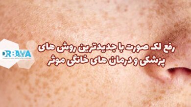 رفع لک صورت با جدیدترین روش های پزشکی و درمان های خانگی موثر