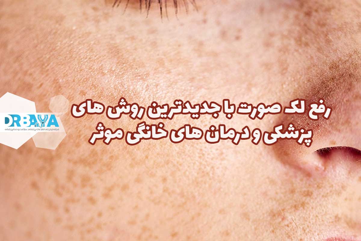 رفع لک صورت با جدیدترین روش های پزشکی و درمان های خانگی موثر