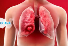 بیماری سرطان ریه؛ علائم، پیشگیری و درمان