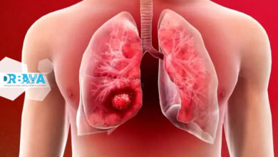 بیماری سرطان ریه؛ علائم، پیشگیری و درمان
