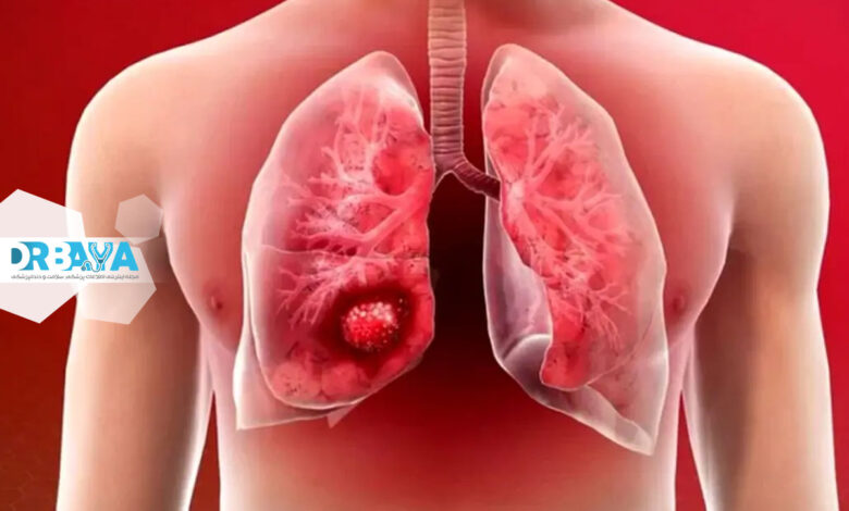 بیماری سرطان ریه؛ علائم، پیشگیری و درمان