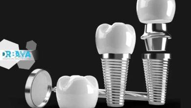 بهترین برند ایمپلنت دندان کدام است؟ مقایسه برندهای معتبر جهانی و انتخاب مطمئن