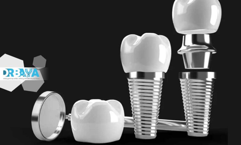 بهترین برند ایمپلنت دندان کدام است؟ مقایسه برندهای معتبر جهانی و انتخاب مطمئن