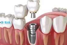 عوارض احتمالی ایمپلنت دندان چیست و چگونه از بروز آنها پیشگیری کنیم؟ راهنمای کامل بیماران