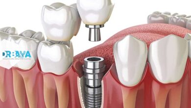 عوارض احتمالی ایمپلنت دندان چیست و چگونه از بروز آنها پیشگیری کنیم؟ راهنمای کامل بیماران