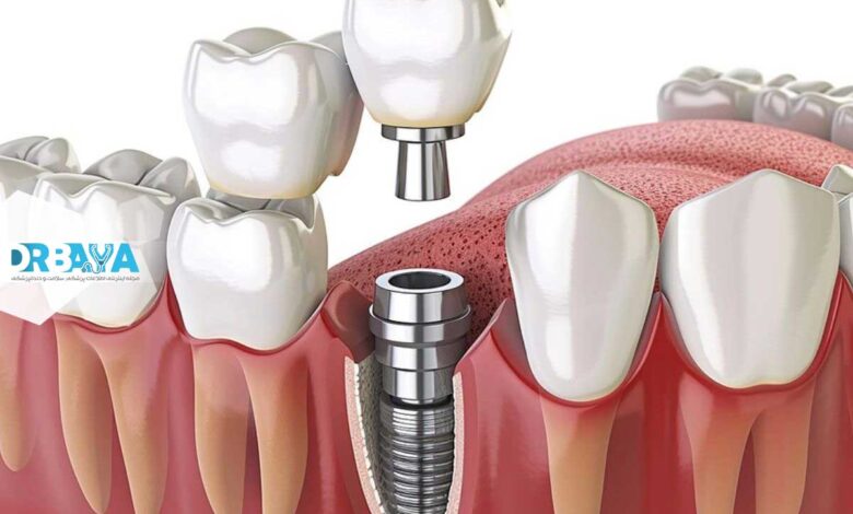 عوارض احتمالی ایمپلنت دندان چیست و چگونه از بروز آنها پیشگیری کنیم؟ راهنمای کامل بیماران