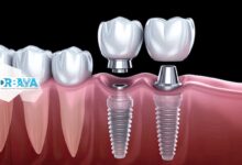 ایمپلنت دندان چیست و چرا بهترین جایگزین دندان از دست رفته است؟