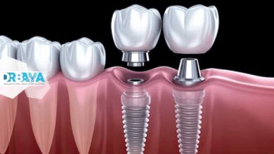 ایمپلنت دندان چیست و چرا بهترین جایگزین دندان از دست رفته است؟