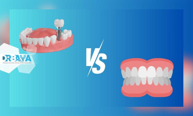 تفاوت ایمپلنت با دندان مصنوعی چیست و کدام گزینه برای شما بهتر است؟ مقایسه کامل مزایا، معایب و هزینه ها